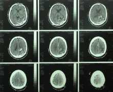 neurosurgery.tv Abdelkareem