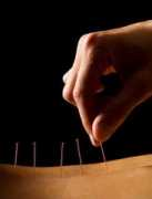 Acupuncture