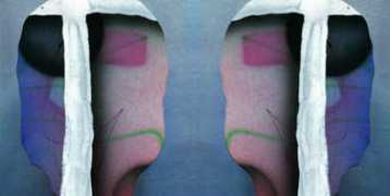 Adfh