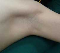hyperhidrosis.cn Ampit