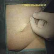 herniasurgery.it Anestesia