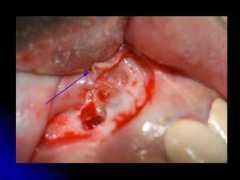 dentalindia.com Apical