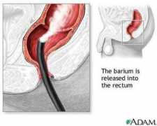 digestivedisease.uthscsa.edu Barium