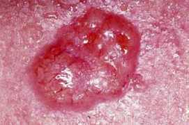 Basal