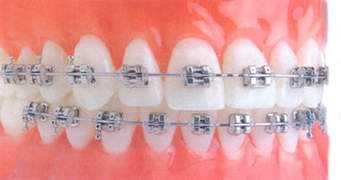 ortodont-clinic.ru Breket
