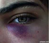 pxleyes.com Bruise
