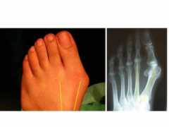 Bunion