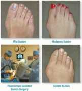 Bunion