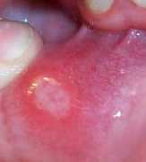 funscrape.com Canker