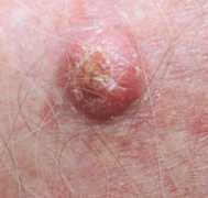 funscrape.com Carcinoma