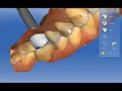 Cerec