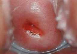 Cervix