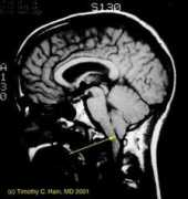 tchain.com Chiari