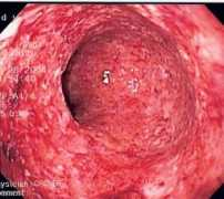 schools-wikipedia.org Colitis