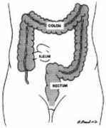 commonwealthsurgical.com Colitis