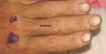 Costra