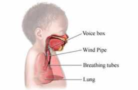 Croup