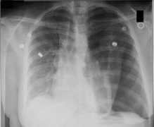 Cxr