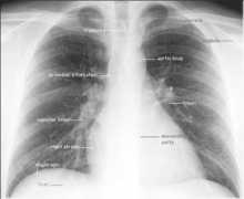 Cxr