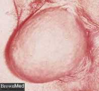 funscrape.com Cyst