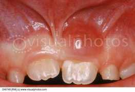 visualphotos.com Cyst