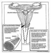 recoveringnicholas.com Dalkon