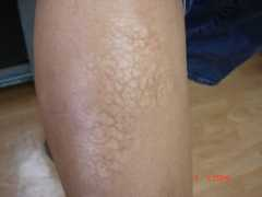 dermpathmd.com Degos