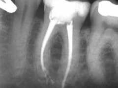 dentalindia.com Distal