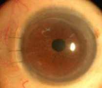 corneaclinic.com Dlek