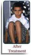 vitiligo.org Drvijay