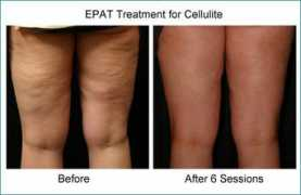 cellulite-seattle.com Epat
