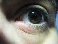 Eyesore