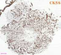 breastpathology.info Florid