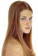 Freckles