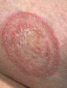 meddic.jp Fungal