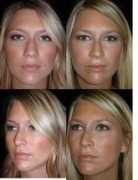 rhinoplastynetwork.com Kanodia