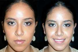 rhinoplastynetwork.com Kanodia