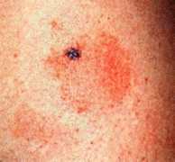 dermotologia.narod.ru Lishai