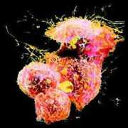 mums.ac.ir Lymphoma
