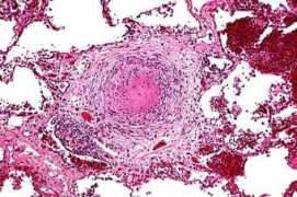 pathhsw5m54.ucsf.edu Miliary