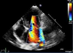 cavalierhealth.com Mitral