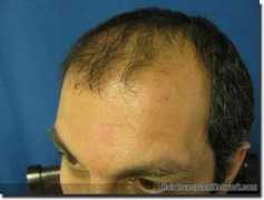 hairtransplantnetwork.com Mohebi