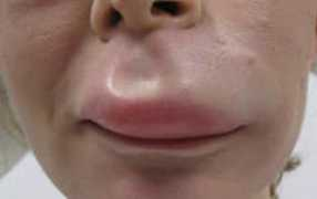 Oteke