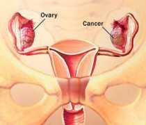 topnews.ae Ovarian