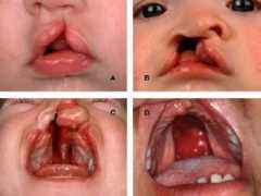 Palate