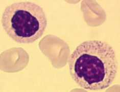 atlasgeneticsoncology.org Pelger