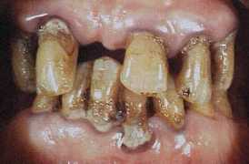 Periodoncia