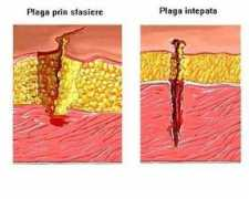 sfatulmedicului.ro Plagi