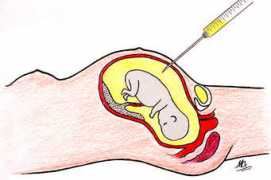 atlasgeneticsoncology.org Prenatal