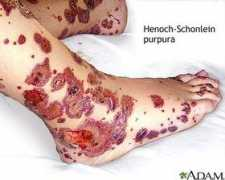 funscrape.com Purpura